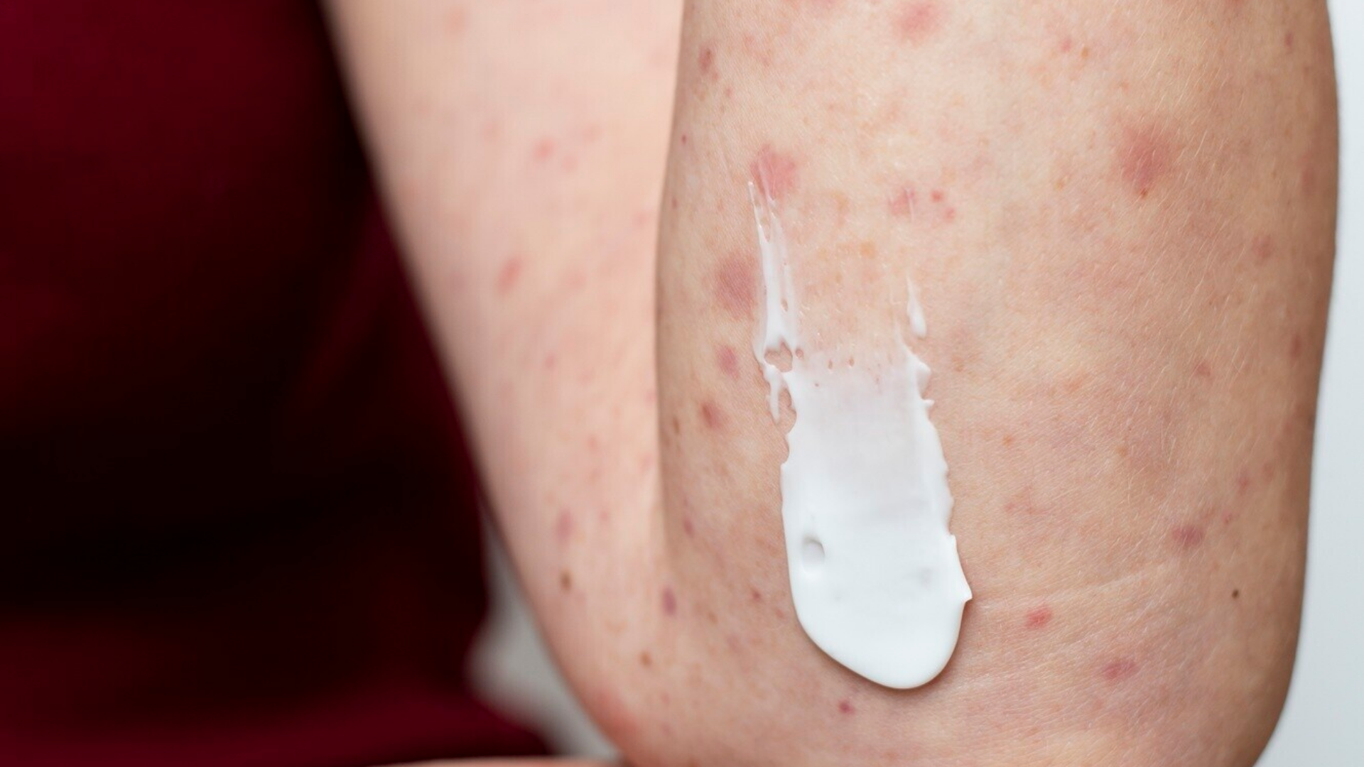 Phát ban da trong giai đoạn đầu nhiễm HIV