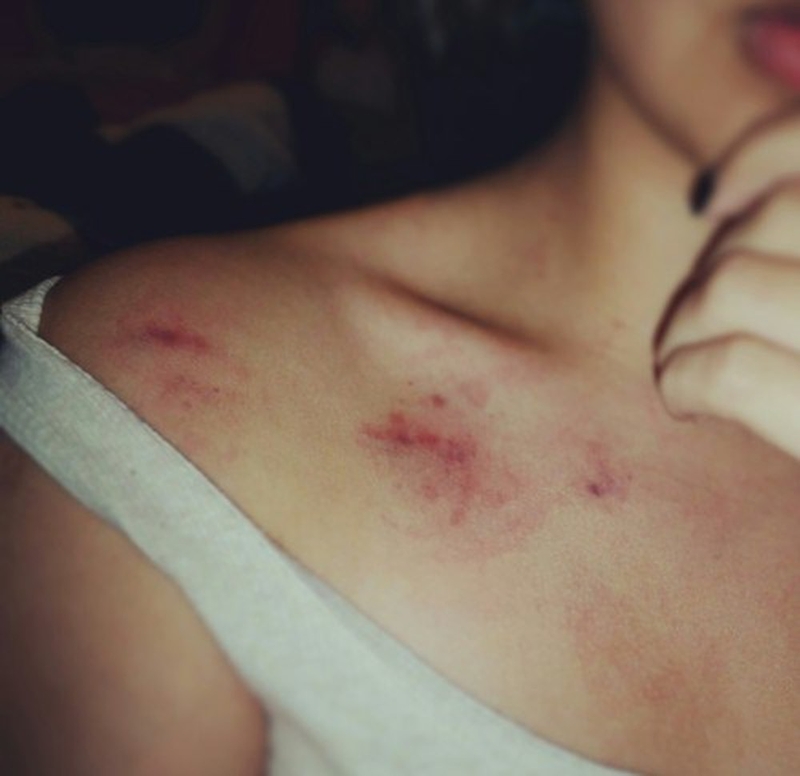Dấu hickey là gì? Hickey có nguy hiểm không?