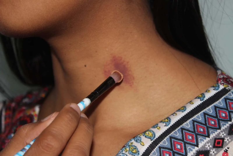 Dấu hickey là gì? Hickey có nguy hiểm không?