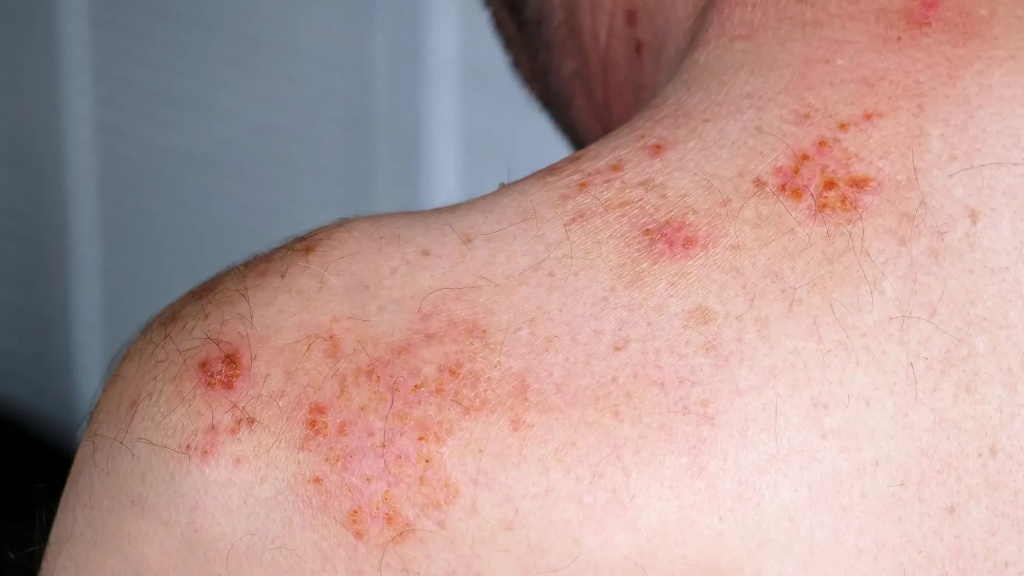 Giời leo giai đoạn hồi phục