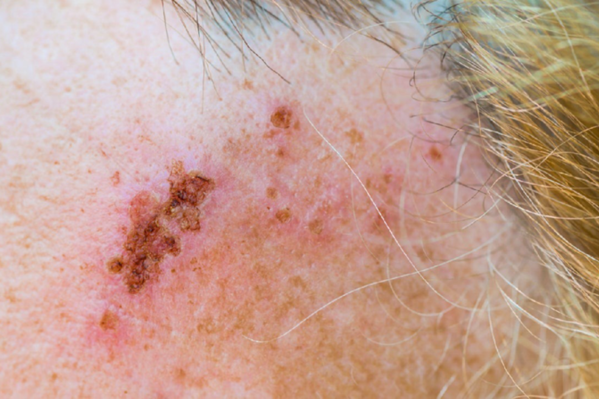 Giời leo vùng mặt