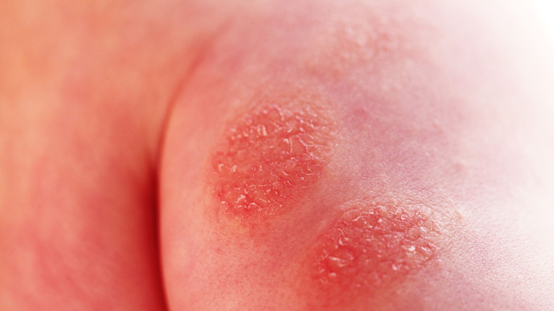 Viêm da dạng herpes